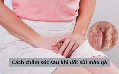 Hướng dẫn cách chăm sóc sau khi đốt sùi mào gà bạn cần biết