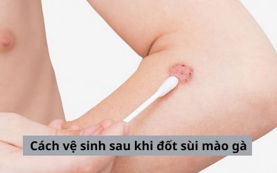 CẬP NHẬT: Cách vệ sinh sau khi đốt sùi mào gà hiệu quả 2024