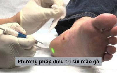 Phương pháp điều trị sùi mào gà hiệu quả hiện nay [Tổng hợp]