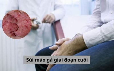 Tất tần tật về sùi mào gà giai đoạn cuối bạn nên biết