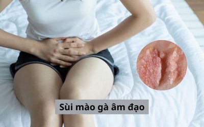 Sùi mào gà âm đạo – Phổ biến nhưng không phải ai cũng hiểu rõ