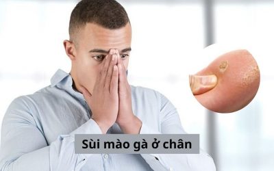 Bị sùi mào gà ở chân có dễ điều trị khỏi hay không?
