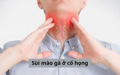 Sùi mào gà ở cổ họng và tất tần tật những vấn đề bạn cần biết!