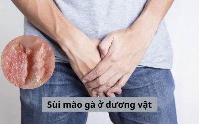 Nam giới cần biết những gì về sùi mào gà ở dương vật