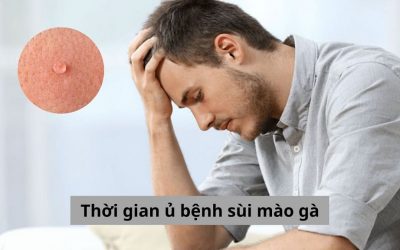 Thời gian ủ bệnh sùi mào gà bao lâu? [Chuyên gia giải đáp]
