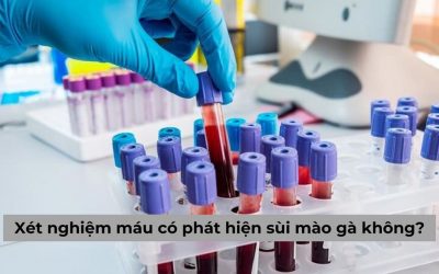 Thực hiện xét nghiệm máu có phát hiện sùi mào gà không?
