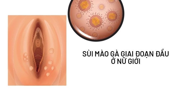 Dấu hiệu ban đầu của bệnh sùi mào gà ở nữ giới 