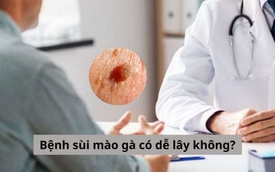 Bệnh sùi mào gà có dễ lây không? Có cách nào để phòng bệnh?
