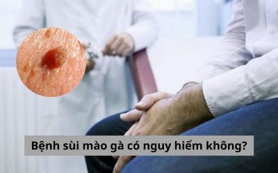 [Góc giải đáp] Bệnh sùi mào gà có nguy hiểm không? 