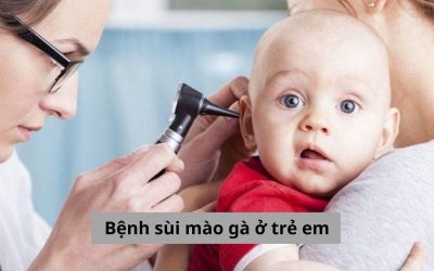 Tìm hiểu: Cập nhật từ A – Z về bệnh sùi mào gà ở trẻ em