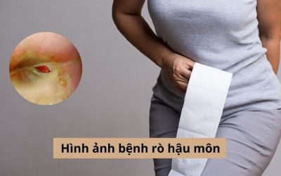 [Tổng hợp] Hình ảnh bệnh rò hậu môn chi tiết và cách điều trị dứt điểm