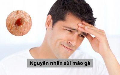 Nguyên nhân sùi mào gà là gì, có cách nào chữa trị hiệu quả?