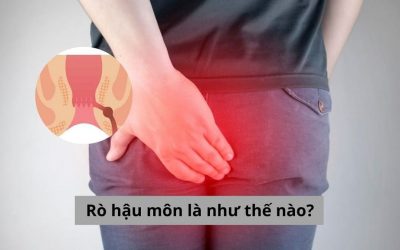 Giải mã chi tiết: Rò hậu môn là như thế nào? Tìm hiểu về bệnh
