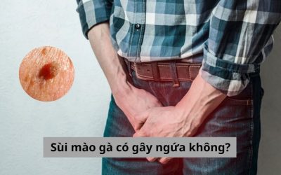 Sùi mào gà có gây ngứa không? Cách phòng ngừa và điều trị bệnh