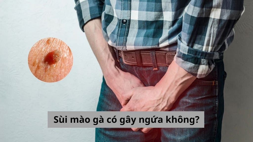 Sùi mào gà có gây ngứa không? Cách phòng ngừa và điều trị bệnh