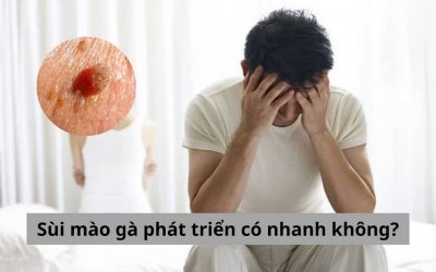 [Giải đáp giúp bạn] Sùi mào gà phát triển có nhanh không?