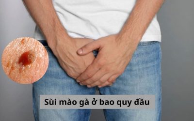 Sùi mào gà ở bao quy đầu – Nam giới cần nắm rõ những gì?