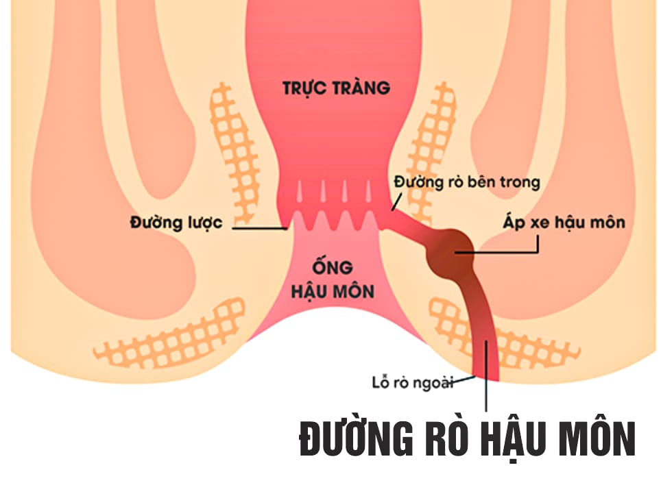 Tìm hiểu chung về áp xe rò hậu môn