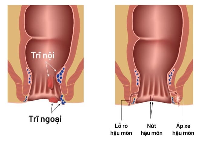 Nguyên nhân bị chảy dịch sau mổ rò hậu môn? 