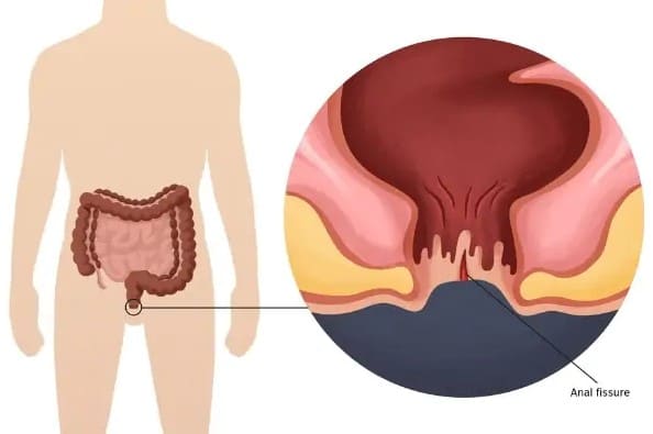 Điều trị rò hậu môn không cần phẫu thuật liệu có tốt?