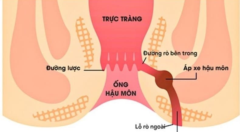 Hình ảnh bệnh rò hậu môn