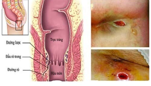 Bị tái phát rò hậu môn sau khi phẫu thuật?