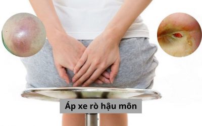 Đừng để áp xe rò hậu môn làm đảo lộn cuộc sống của bạn