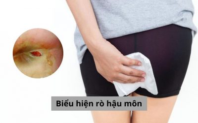5 Biểu hiện rò hậu môn cần nhận biết sớm và điều trị hiệu quả [Tổng hợp]