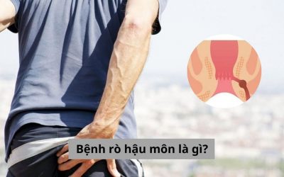 Bệnh rò hậu môn là gì? Tổng hợp các vấn đề liên quan bạn cần biết