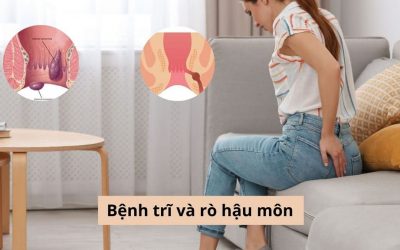 Bệnh trĩ và rò hậu môn: Cách phân biệt và điều trị cụ thể