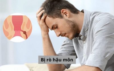 Bị rò hậu môn và tất tần tật những vấn đề người bệnh nên biết