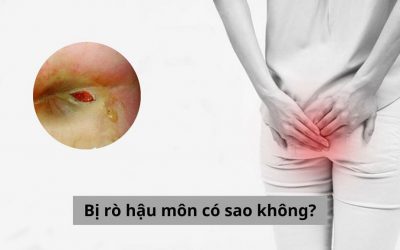 Bị rò hậu môn có sao không và cách điều trị hiện nay