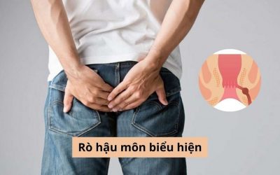 Tìm hiểu: Rò hậu môn biểu hiện ra sao, chữa trị thế nào?