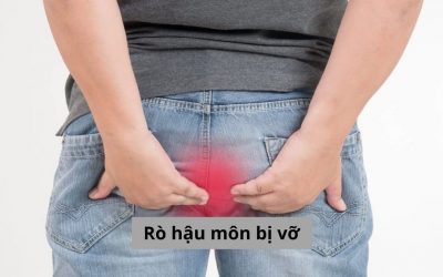 Rò hậu môn bị vỡ và những thông tin bạn không nên bỏ lỡ