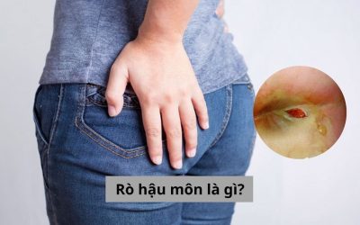 Rò hậu môn là gì: Tìm hiểu về khái niệm, triệu chứng và cách điều trị