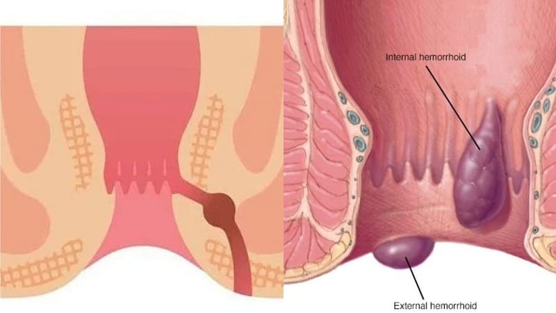 Triệu chứng bệnh trĩ và rò hậu môn 