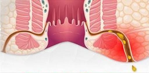 Bệnh rò hậu môn là gì? 