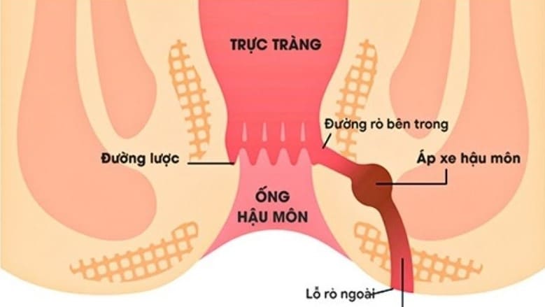 Rò hậu môn đơn giản và những dấu hiệu nhận biết