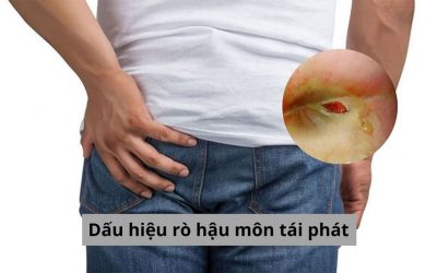 Dấu hiệu rò hậu môn tái phát: Bạn cần biết những điều này