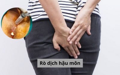 Rò dịch hậu môn: Tìm hiểu nguyên nhân và cách điều trị