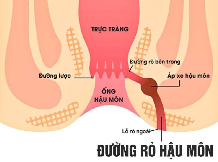 Điều trị rò hậu môn có thật sự cần thiết?