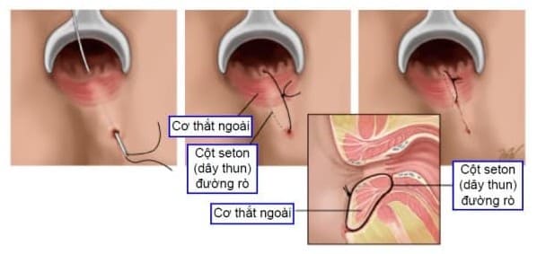 Đặt seton đường rò