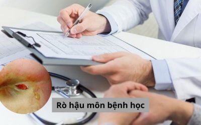 Rò hậu môn bệnh học: Nguyên nhân, dấu hiệu, chẩn đoán và điều trị 
