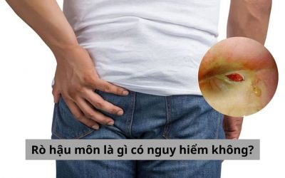 Giải đáp thắc mắc: Rò hậu môn là gì có nguy hiểm không?