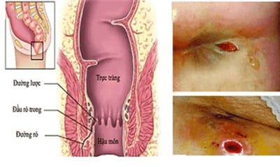 Nhận biết các triệu chứng, phân loại rò hậu môn