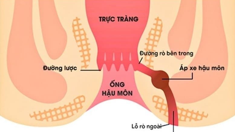 Đường rò hậu môn trực tràng là gì?