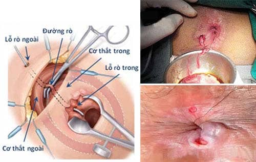 Biến chứng hậu phẫu rò hậu môn