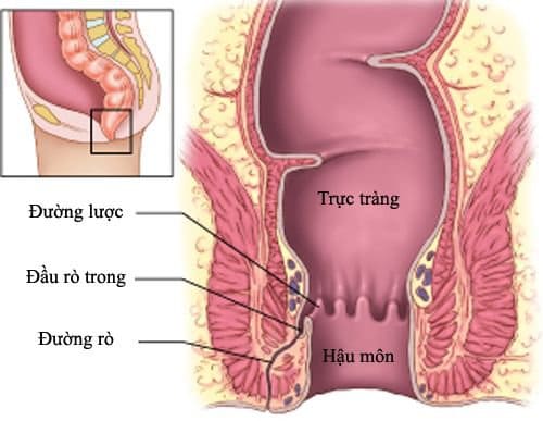 Hiện tượng rò hậu môn