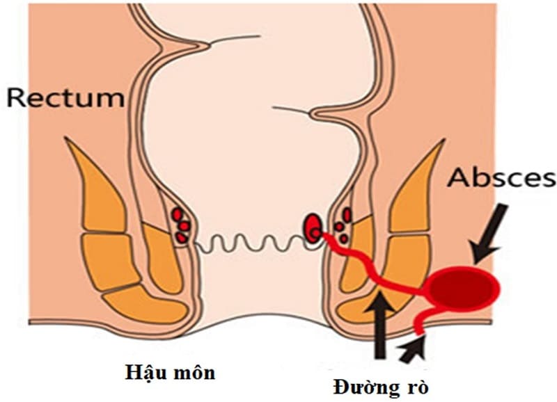 Rò hậu môn áp xe hóa có nguyên nhân do đâu?