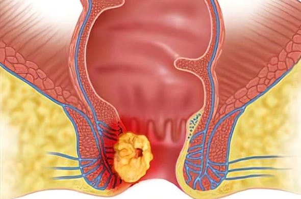 Biến chứng của bệnh gây hại cho hậu môn 